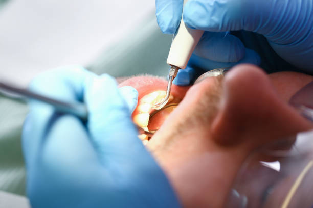 Best Emergency Dental Care for Abscessed Tooth in Warrensburg, MO